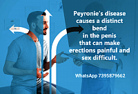 PEYRONIE BEND penis